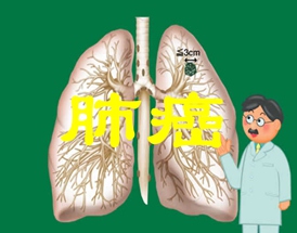 肺癌晚期能活多久？有3个决定因素